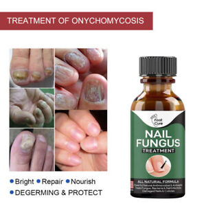 Foot Cure Nail Fungus Treatment