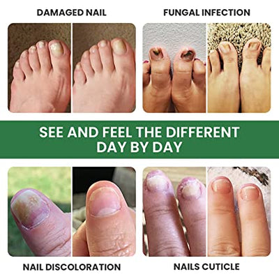 Foot Cure Nail Fungus Treatment
